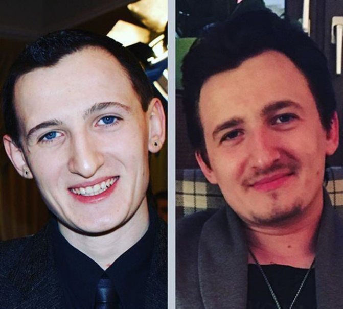 влад кадони до и после пластики